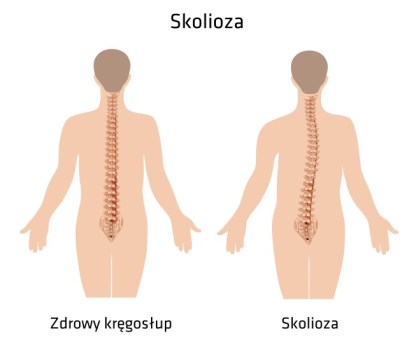 skolioza